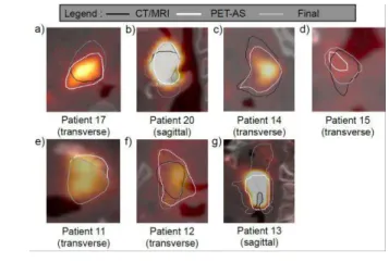 Figure 2. GTV CT/MRI , GTVp ATLAAS , and GTVp final  compared for 7 clinical cases. 