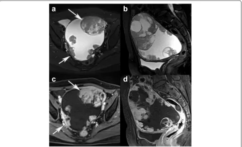 Fig. 1 A 53-year-old woman with left ovarian clear cell carcinoma (CCC). Axial and sagittal turbo spin echo (TSE) T2-weighted imaging (T2WI) withfat saturation (FS) (a-b) show an oval unilocular cystic mass with papillary projections (arrows)