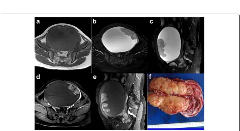 Fig. 2 A 50-year-old woman with bilateral high-grade serous carcinoma (HGSC). Axial and sagittal TSE T2WI with FS (a-b), axial T1WI (c) and sagittalcontrast-enhanced flash 2D T1WI with FS (d) show the irregular solid mass appearing with iso-intensity on T1
