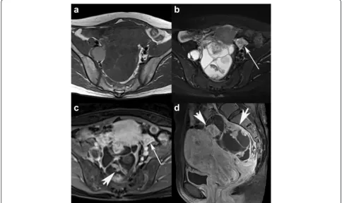 Fig. 4 A 42-year-old woman with HGSC in the right ovary. Axial SE T1WI and TSE T2WI with FS (a-b) show a mulitlocular cystic mass with multiplesmall papillary projections