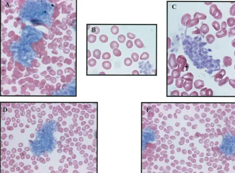 Fig 1. A compilation of several photomicrographs that were taken from a single blood film made without anticoagulant and stained withWright/Giemsa (A, D, and E: original magnification �400; B and C: original magnification �1000).
