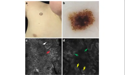 Fig. 1 Spitz nevus localized on the shoulder (a). Dermoscopy showed a starbust pattern with multiple pigmented striations and large brown globulesdistributed symmetrically at the periphery of the lesion (b)