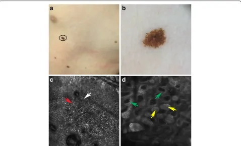 Fig. 2 Spitz nevus localized on the trunk (a). Dermoscopy showed a globular pattern with regular, brownish central pigmentation and brownishglobules at the periphery of the lesion (b)