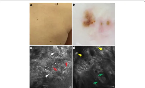 Fig. 3 Spitz nevus localized on the back (a). Dermoscopy showed a multicomponent pattern with irregular pigmentation and a whitish-blueveil (b)