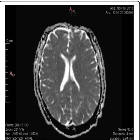Fig. 1 MRI diffusion sequences showing restricted diffusion in theleft temporal parietal and occipital areas