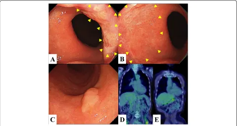 Fig. 1 Endoscopy and FDG-PET/CT findings. a, b Endoscopy findings, showing a mild granular elevated lesion with slightly depressed irregularmucosa extending from the anterior wall to the right wall of the distal esophagus (arrowheads)