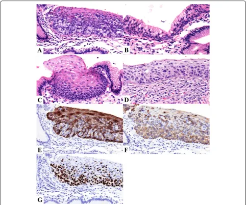 Fig. 3 Microscopic findings. a Hematoxylin and eosin staining of a tumor section, showing neoplastic cells (Paget cells) with a large nucleus anda pale-staining cytoplasm in the lower part of the esophageal epithelium