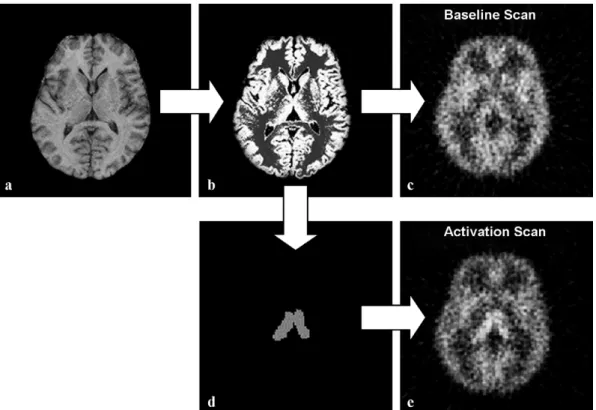 Fig. 1. Simulation of PET scans: (a) initial MR image, (b) segmented image representing relative tracer concentrations, (c) simulated baseline [ 15 O]-H 2 O PET scan, (d) thalamus segmentation mask, (e) simulated scan with activation in the thalamic region