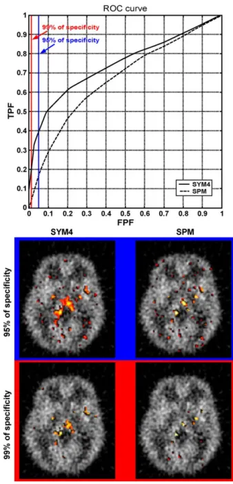 Fig. 4. Sensitivity at specificity levels of 95% and 99% obtained with the wavelet-based and spatial-domain statistical methods.