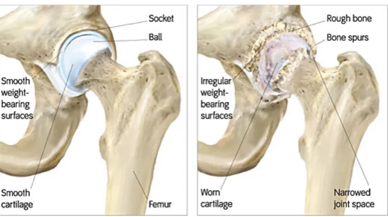 Figure 2.4.  Comparing the arthritis and healthy hip joint [2] 