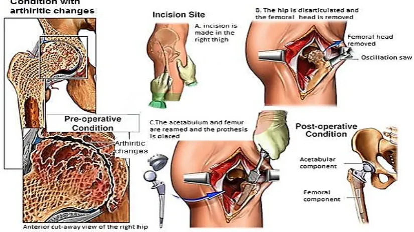 Figure 2.11. THR surgery process [7] 