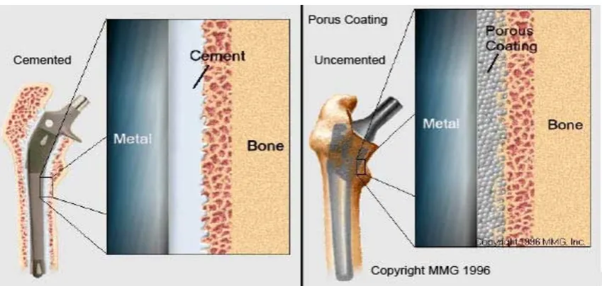 Figure 2.13. Illustration of cemented and un-cemented method [18] 