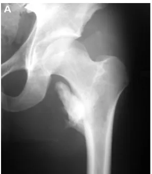 Figure 2.14. Class three of the heterotopic ossification [27] 