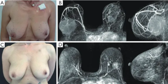 Figure 2 Clinical complete response to neoadjuvant chemotherapy. (A) Patient presenting with a massive T4 ductal carcinoma of the  left breast with skin infiltration; (B) magnetic resonance reconstructions, confirming a 9-cm left breast malignant neoplasm,