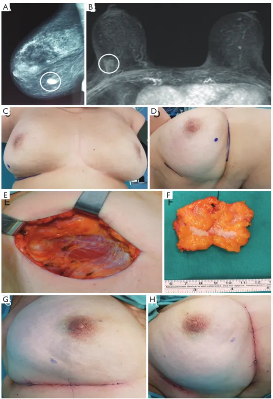 Figure 3 Oncoplastic inframammary fold approach of a lower outer right breast carcinoma