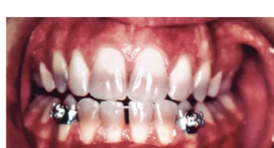 Fig 1. Moderate fluorosis.