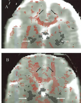 Fig 3. MRI DTI: comparison of controland experimental group infants at 2weeks’ corrected age
