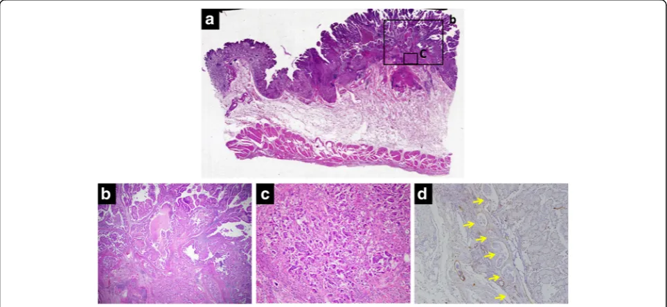 Fig. 3 Histopathological examination of the corpus region showed small and large polyps and one elevated lesion ((hyperplastic foveolar epithelium, cystically dilated glands, and edematous stroma accompanied by chronic inflammation, indicating hamartomatou