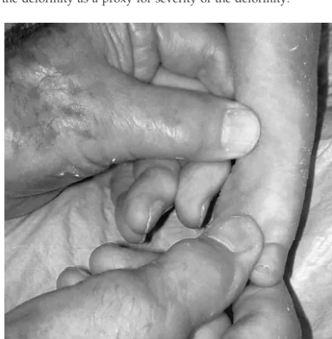 Fig 1. Manipulation as described by Ponseti. The thumb is posi-tioned over the lateral aspect of the head of the talus, and theindex finger is positioned behind the lateral malleolus