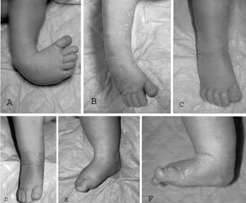 Fig 3. Foot-abduction brace. The brace consists of a bar withaffected side and 40° on the normal side