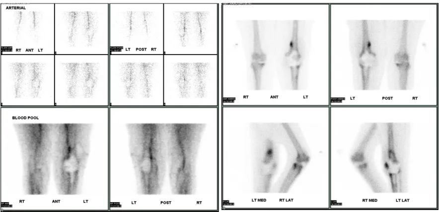 Figure 2c: Arterial & venous phase images showing minimally increased uptake in the symptomatic left knee prosthesis