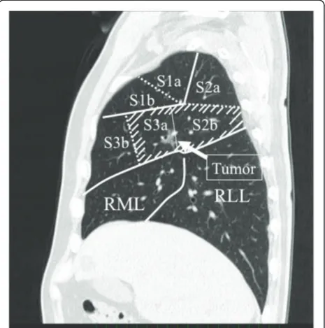 Figure 1 Sagittal image of CT. The tumor located between theright subsegment 2b and 3a.