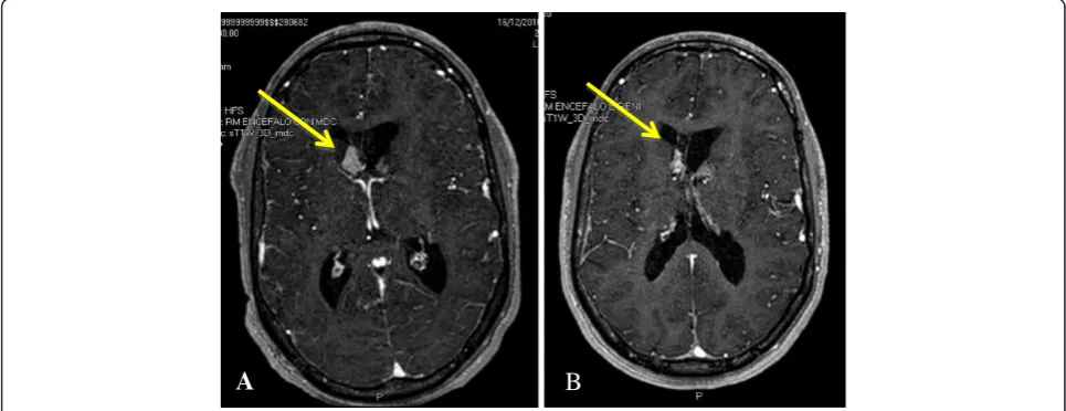 Figure 1 SEGA volume reduction during Everolimus treatment.presented a new episode of subacute hydrocephalus, which required an external derivation