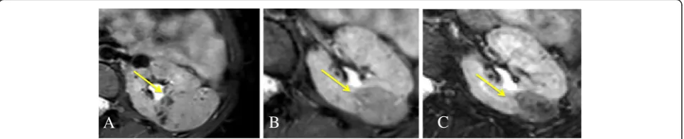 Figure 3 Progressive reduction of renal AMLs. A girl with a TSC2 mutation presented renal AMLs since childhood, with no impairment ofrenal function but with a progressivre growth both in number and in size