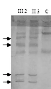 Fig 3. Screening of mutations in exon 20 of the AE1 gene inpatients with dRTA by PCR-SSCP analysis