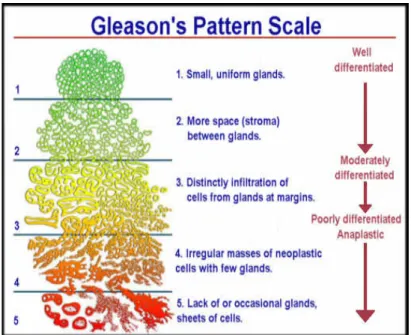 Figure 2.5 Gleason’s Pattern Scale. (Adapted from 