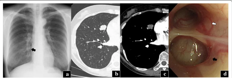 Fig. 2 Macroscopic and microscopic findings of the pulmonary nodule.by the adjacent bronchioles andthe duct-forming component and a Cut surface of the surgical specimen