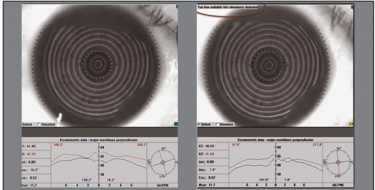 Figure 1. Normal photo capture in the right eye. Th   e “Too few suitable iris structures detected” error was shown during examination of the  left eye with the Topolyzer Vario.
