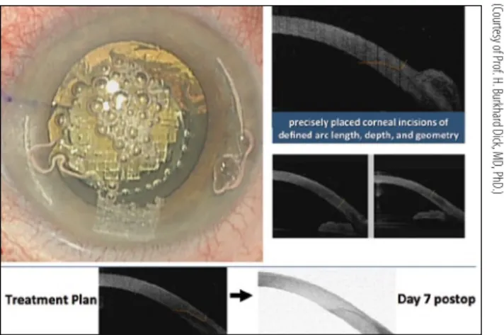Figure 5.  The OCT visualization of the eye’s intraoperative  anatomy informs the surgeon’s decision making.