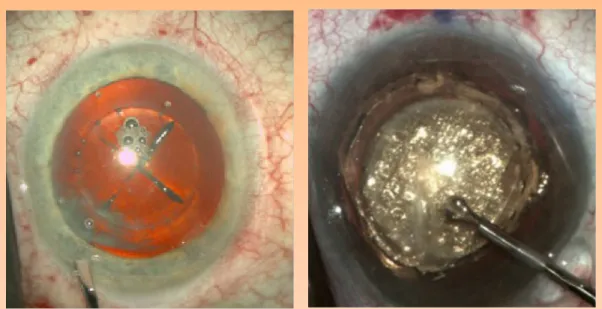 Figure 2. Lens fragmentation patterns. Left: A basic 2-cut cross pattern used for soft cataracts