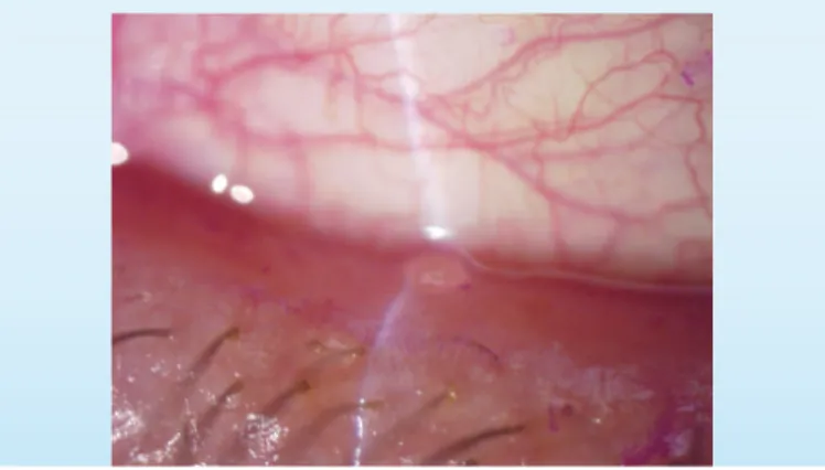 Figure 1. This slit-lamp image shows evidence of meibomian gland dysfunction and findings consistent with giant papillary conjunctivitis.
