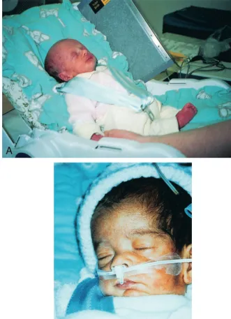 Fig 2. A, Photograph showing an in-fant asleep with the insert in position.The X-ray plate is in place on the leftside of the infant