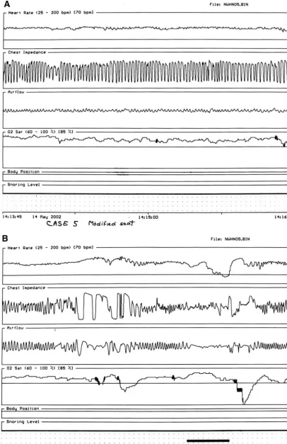 Fig 5. Polygraph tracings from the infant whose radiographs are presented in Fig 4, with the insert in place showing a normal recordingshown by increased heart rate and respiratory excursion but reduced airflow