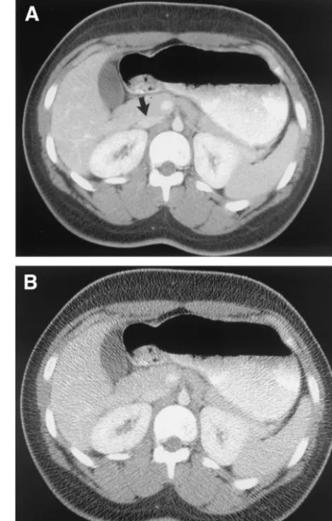 Fig 1. Effect of reduced radiation dose on CT image quality in a14-year-old female involved in a motor vehicle collision
