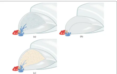 Figure 1 Schema of pleural closure and mesh-cover treatment on intersegmental planepreserving intersegmental vein