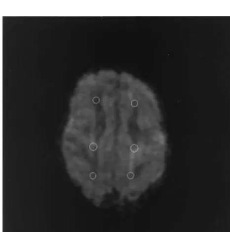 Fig 1. Positioning of ROIs in the white matter at the level of thecentrum semiovale on the read DWI.