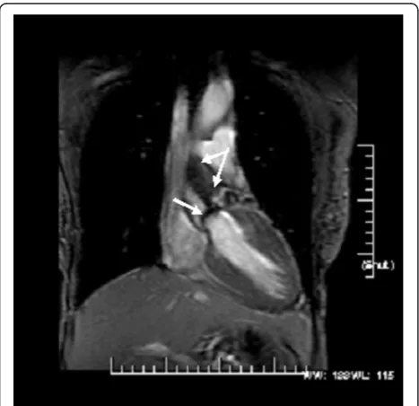 Figure 1 A coronal view from a steady-state free precessionacquisition demonstrating the heavily calcified (arrow) andrestricted aortic valve leaflets with a intervoxel dephasingdefect as depicted by the systolic turbulence (bifid arrow)radiating into the 