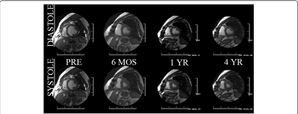 Figure 2 Serial cardiovascular MRI mid short-axis images in diastole (top row) and systole (bottom row) in a 76 WM taken the dayprior to AVR, 6 months, one year and 4 years following AVR