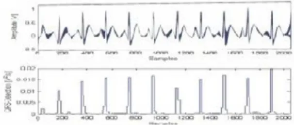 Fig 2.  Before and After the Pre-processing of ECG signal 
