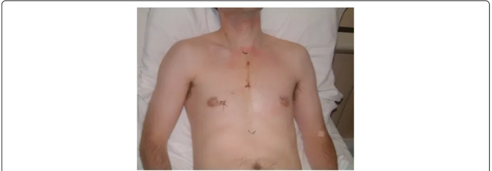 Fig. 3 Post-operative scar following J-shaped partial upper sternotomy for MAAVR