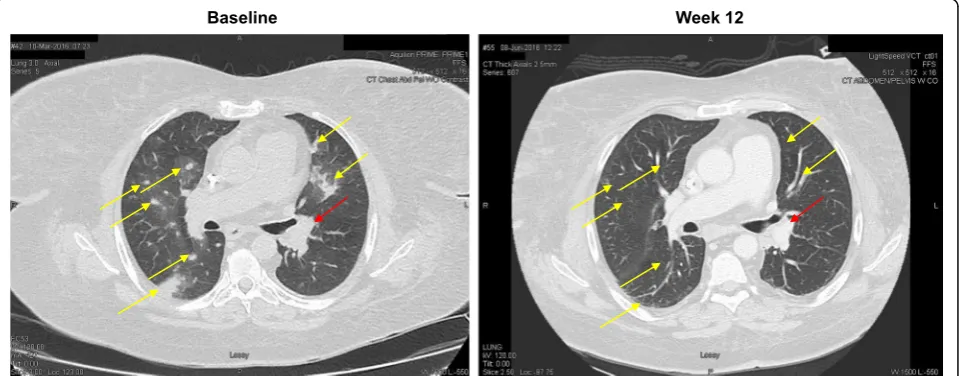 Fig. 1 Radiographic response to nivolumab on hemodialysis; CT chest exams performed at baseline and 12 weeks after re-initiation of therapydemonstrates resolution of lung nodules (indicated by the yellow arrows)