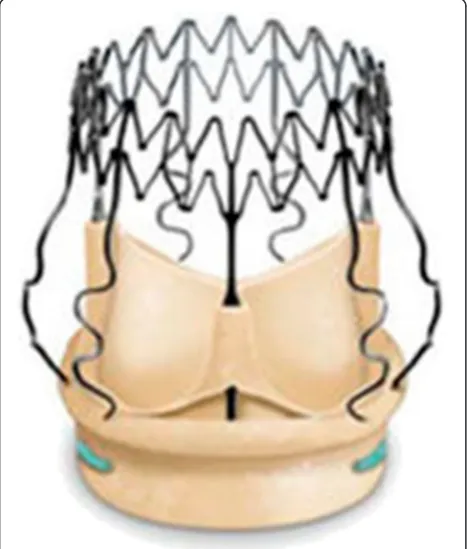 Fig. 3 In order to minimize or avoid the paravalvular leakage, thePerceval S valve is designed with an intra–annular and a supra–annularsealing collar