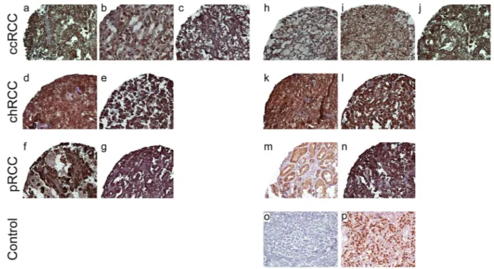 Figure 1.  Immunohistochemical (IHC) Analysis of OCT4 Expression in Different Renal Cell Carcinoma  (RCC) Samples