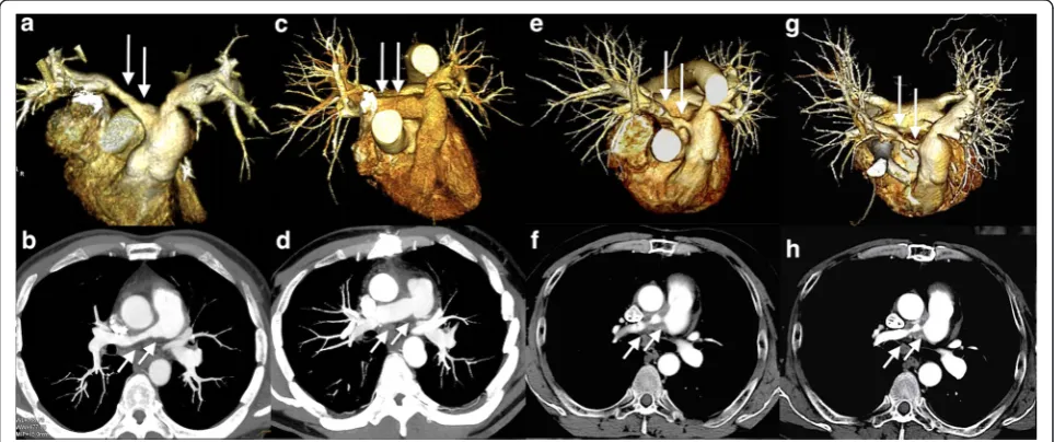 Table 1 Summary of the surgery for isolated pulmonary TA