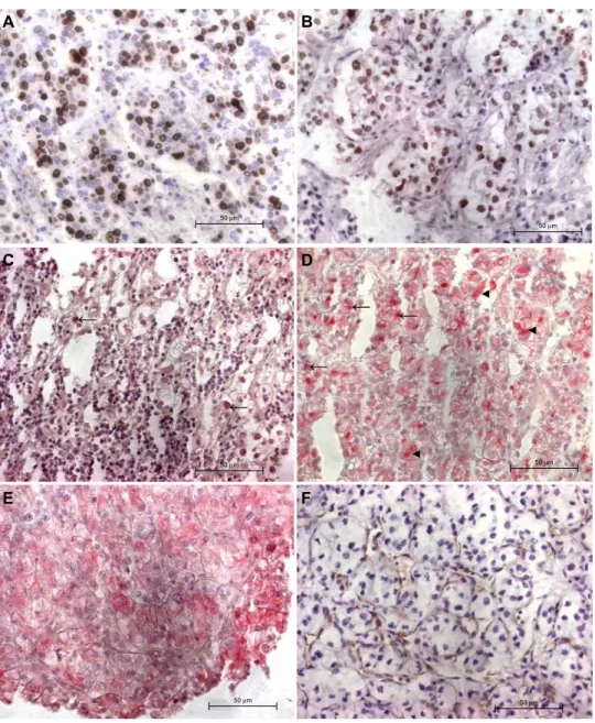 Figure 1 representative ccrcc cores with positive immunohistochemical stainings.