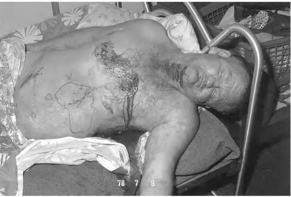 Figure 7.1Deceased showing tentative cuts to the neck and major chest wound which caused his death – note the map of Australia in reverse which was tattooed by the deceased whilst looking onto a mirror when he was a prisoner in goal 